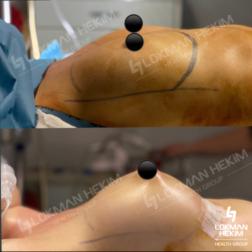 Mommy Makeover Surgery Before / After photo